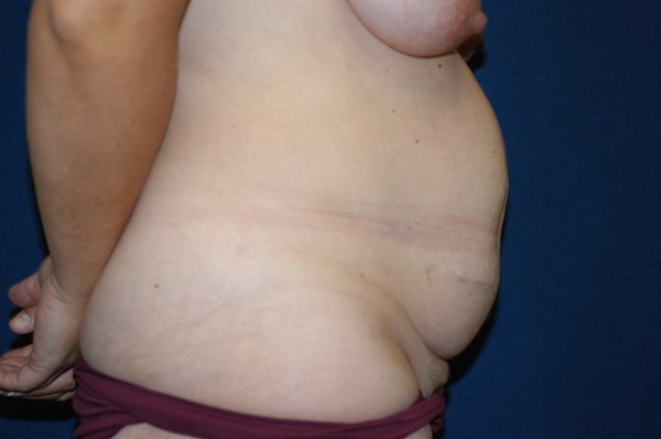 Tummy Tuck Before & After Gallery - Patient 247883 - Image 5