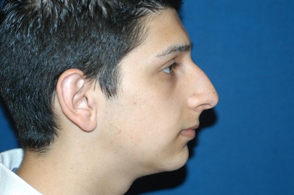 Rhinoplasty Before & After Gallery - Patient 553043 - Image 1