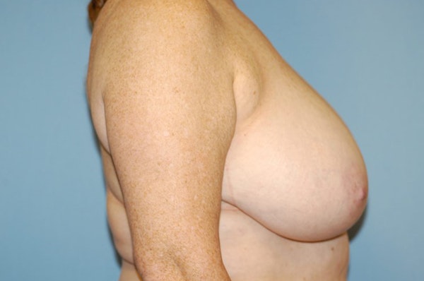 Breast Reduction Before & After Gallery - Patient 289551 - Image 5