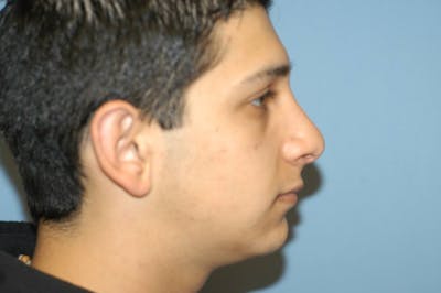 Rhinoplasty Before & After Gallery - Patient 553043 - Image 2