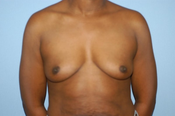Breast Augmentation Before & After Gallery - Patient 317493 - Image 1