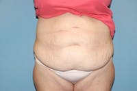 Tummy Tuck Before & After Gallery - Patient 332964 - Image 1