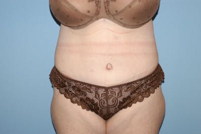Tummy Tuck Before & After Gallery - Patient 332964 - Image 2