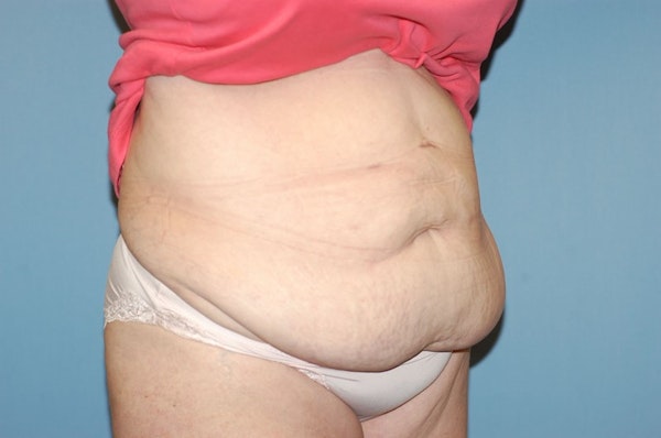 Tummy Tuck Before & After Gallery - Patient 332964 - Image 3