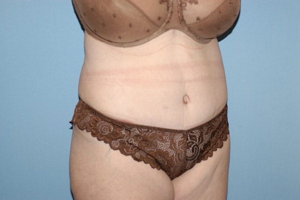 Tummy Tuck Before & After Gallery - Patient 332964 - Image 4