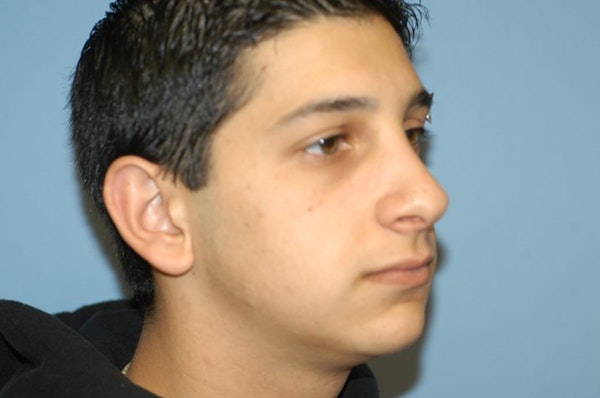Rhinoplasty Before & After Gallery - Patient 553043 - Image 6