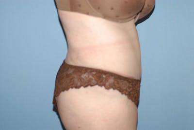 Tummy Tuck Before & After Gallery - Patient 332964 - Image 6