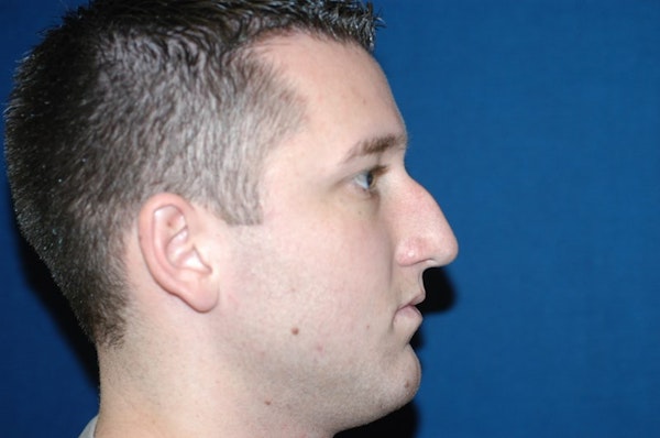 Rhinoplasty Before & After Gallery - Patient 377321 - Image 1