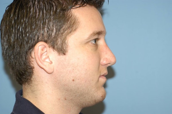 Rhinoplasty Before & After Gallery - Patient 377321 - Image 2