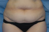 Tummy Tuck Before & After Gallery - Patient 278501 - Image 1