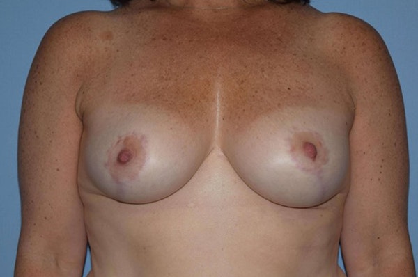 Breast Reduction Before & After Gallery - Patient 616343 - Image 2