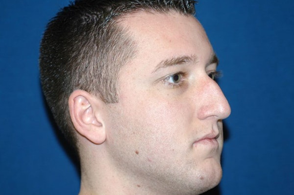 Rhinoplasty Before & After Gallery - Patient 377321 - Image 5