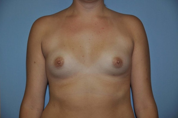 Breast Augmentation Before & After Gallery - Patient 149324 - Image 1