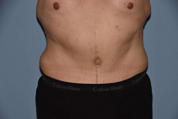 Tummy Tuck Before & After Gallery - Patient 149380 - Image 2