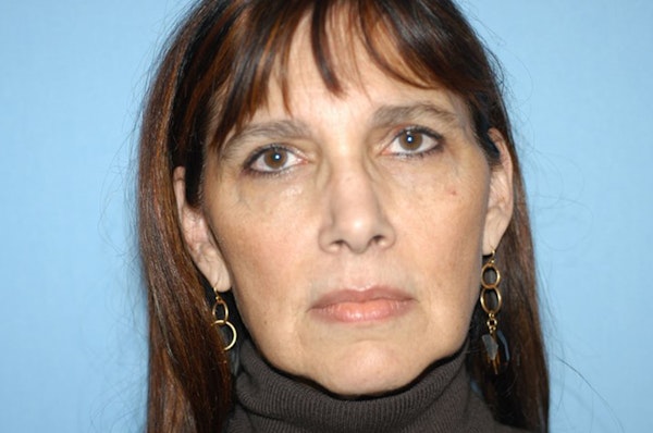 Facelift Before & After Gallery - Patient 337456 - Image 1