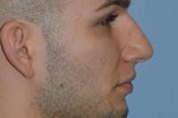 Rhinoplasty Before & After Gallery - Patient 306630 - Image 1