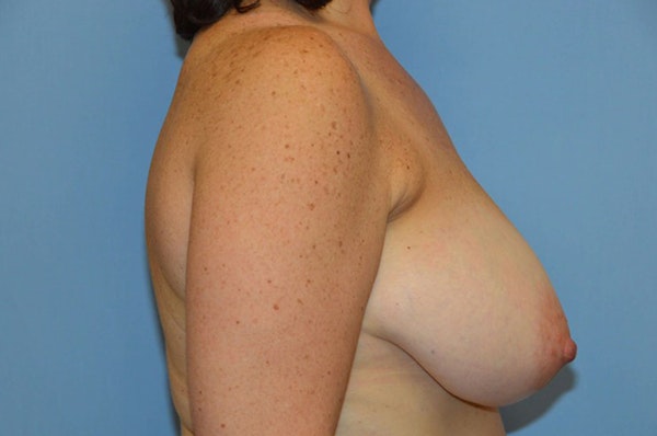 Breast Reduction Before & After Gallery - Patient 616343 - Image 5