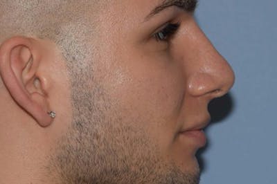 Rhinoplasty Before & After Gallery - Patient 306630 - Image 2
