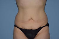 Tummy Tuck Before & After Gallery - Patient 425245 - Image 1