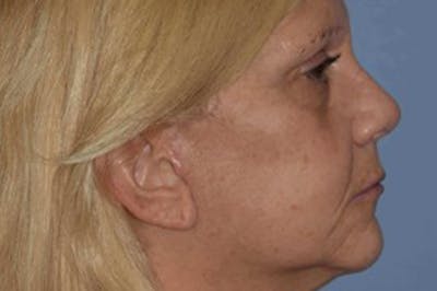 Rhinoplasty Before & After Gallery - Patient 339454 - Image 2