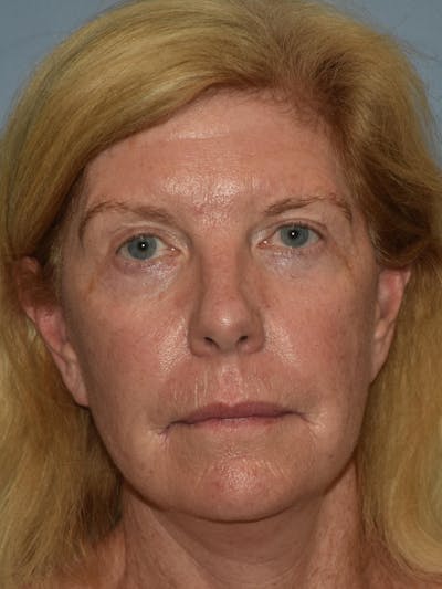 Facelift Before & After Gallery - Patient 109191 - Image 2