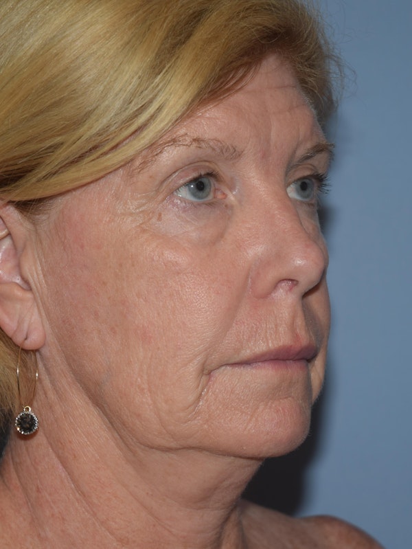 Facelift Before & After Gallery - Patient 109191 - Image 3
