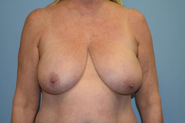 Breast Reduction Before & After Gallery - Patient 897985 - Image 1