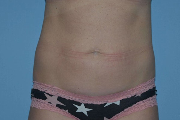 Tummy Tuck Before & After Gallery - Patient 101810 - Image 1