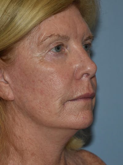 Facelift Before & After Gallery - Patient 109191 - Image 4
