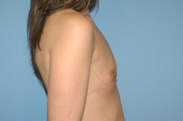 Breast Augmentation Before & After Gallery - Patient 428388 - Image 5