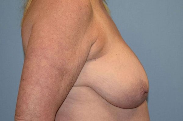 Breast Reduction Before & After Gallery - Patient 897985 - Image 5