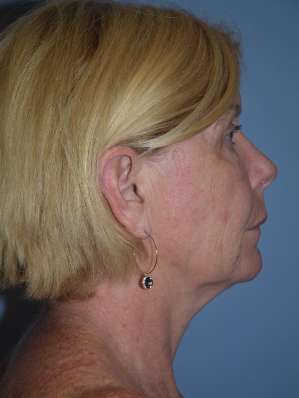 Facelift Before & After Gallery - Patient 109191 - Image 5