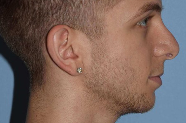 Rhinoplasty Before & After Gallery - Patient 380482 - Image 2