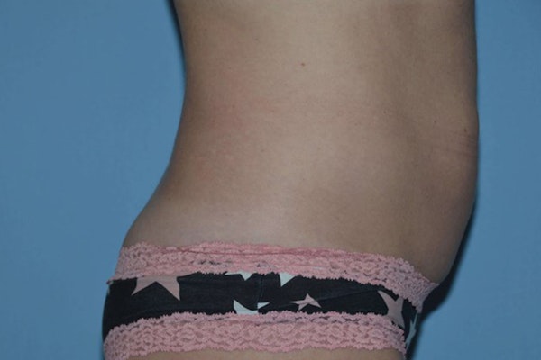 Tummy Tuck Before & After Gallery - Patient 101810 - Image 5