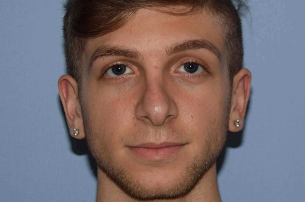 Rhinoplasty Before & After Gallery - Patient 380482 - Image 4