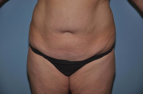 Tummy Tuck Before & After Gallery - Patient 256275 - Image 1