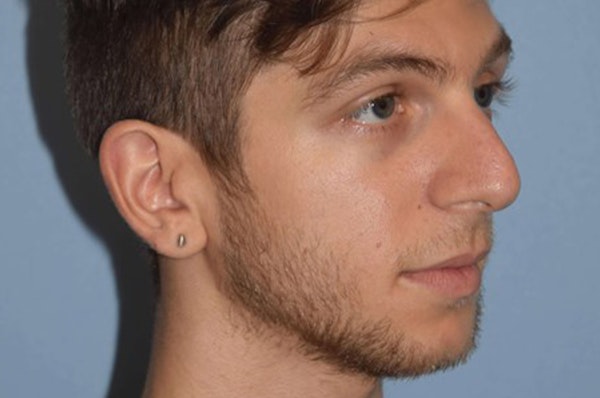 Rhinoplasty Before & After Gallery - Patient 380482 - Image 5