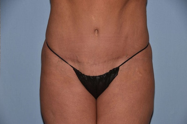 Tummy Tuck Before & After Gallery - Patient 256275 - Image 2