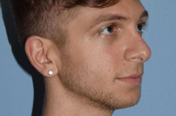 Rhinoplasty Before & After Gallery - Patient 380482 - Image 6