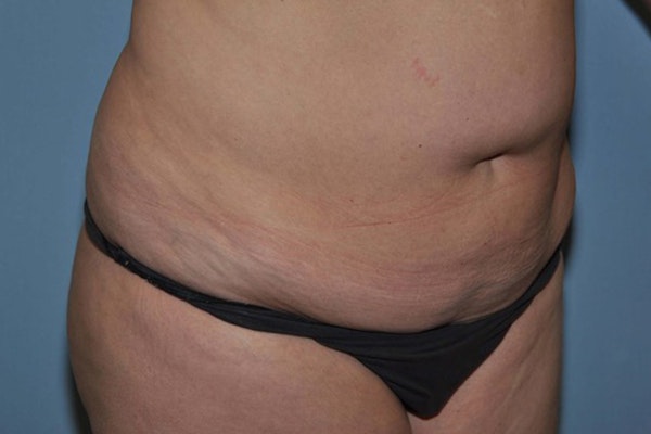 Tummy Tuck Before & After Gallery - Patient 256275 - Image 3