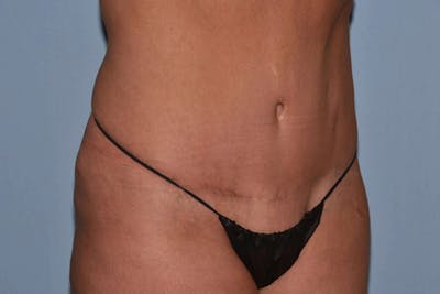 Tummy Tuck Before & After Gallery - Patient 256275 - Image 4
