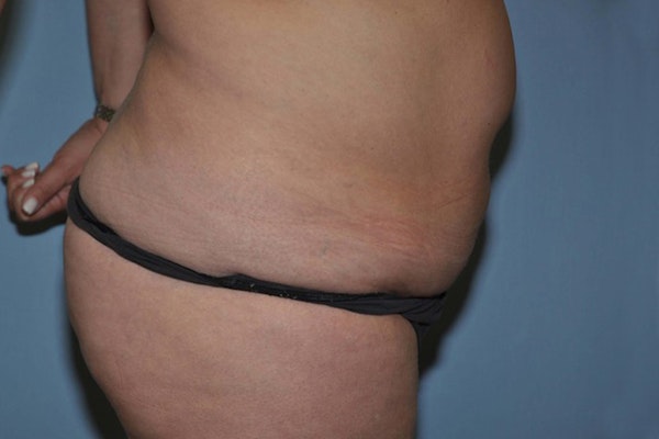 Tummy Tuck Before & After Gallery - Patient 256275 - Image 5