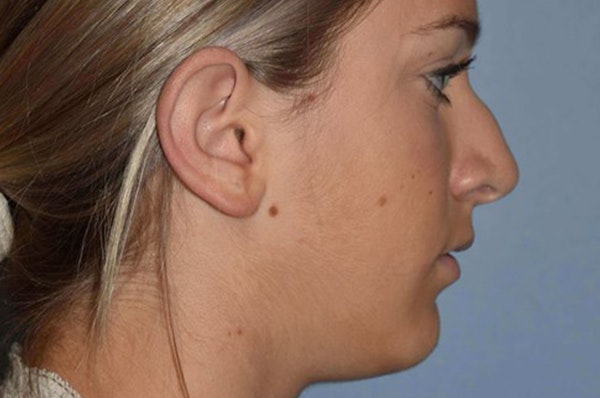 Rhinoplasty Before & After Gallery - Patient 240806 - Image 1
