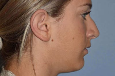 Rhinoplasty Before & After Gallery - Patient 240806 - Image 1