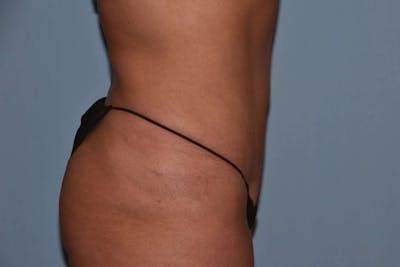 Tummy Tuck Before & After Gallery - Patient 256275 - Image 6