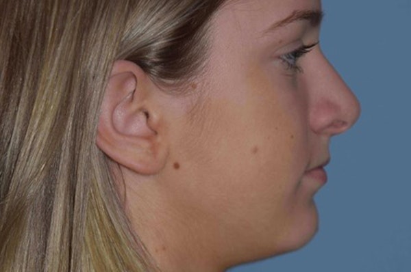 Rhinoplasty Before & After Gallery - Patient 240806 - Image 2