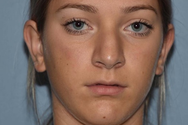 Rhinoplasty Before & After Gallery - Patient 240806 - Image 3