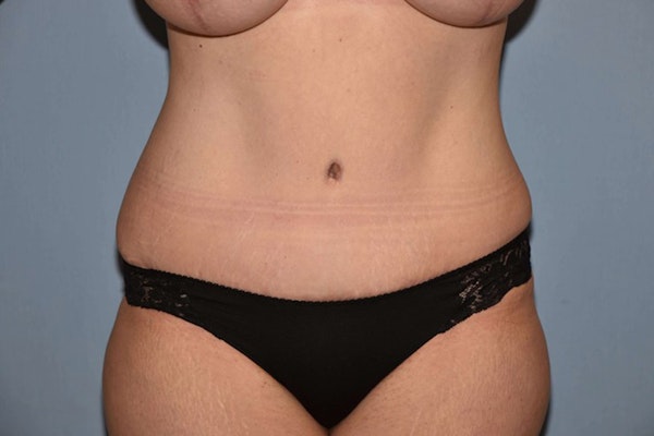 Tummy Tuck Before & After Gallery - Patient 249967 - Image 2