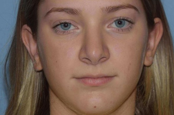 Rhinoplasty Before & After Gallery - Patient 240806 - Image 4