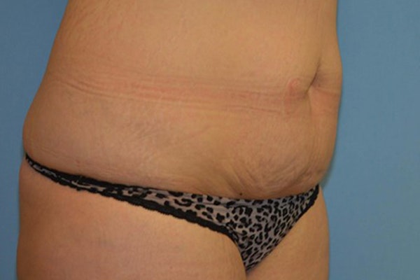 Tummy Tuck Before & After Gallery - Patient 249967 - Image 3